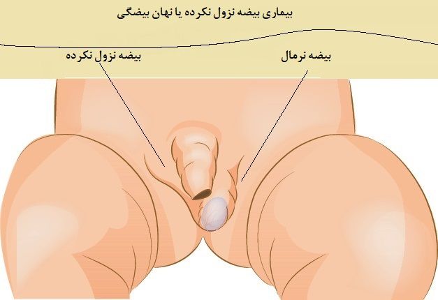 عکس نهان بیضگی یا بیضه نزول نکرده 