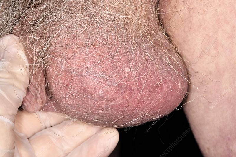 عکس ورم بیضه