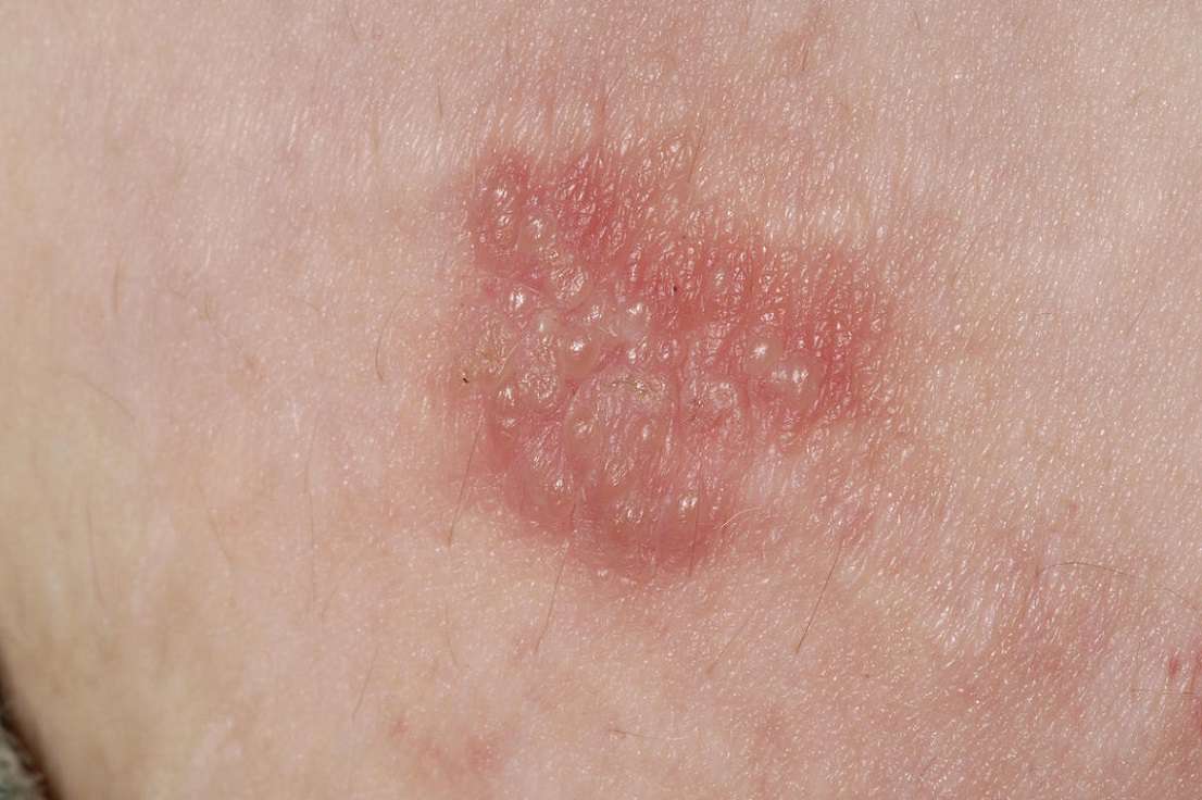 تصاویر تبخال تناسلی