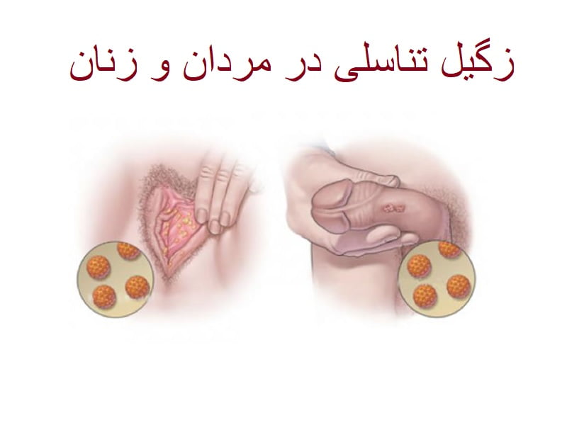 زگیل تناسلی