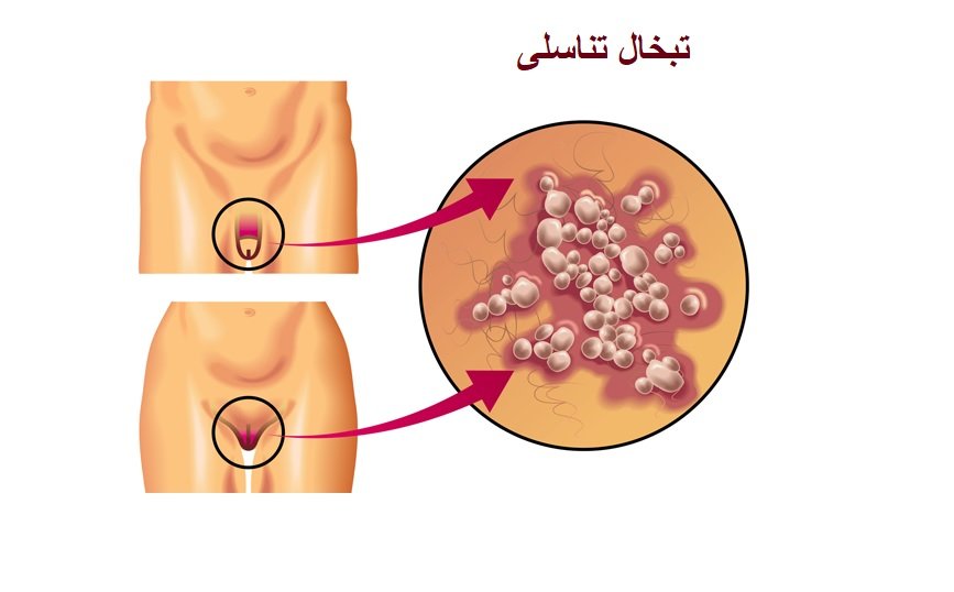 تبخال تناسلی
