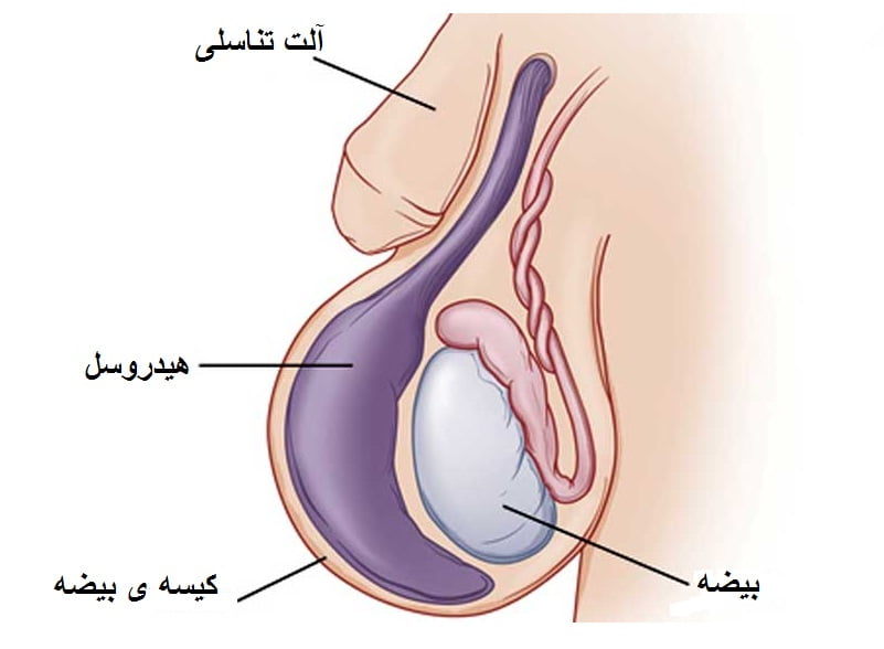 هزینه عمل هیدروسل چقدر است؟