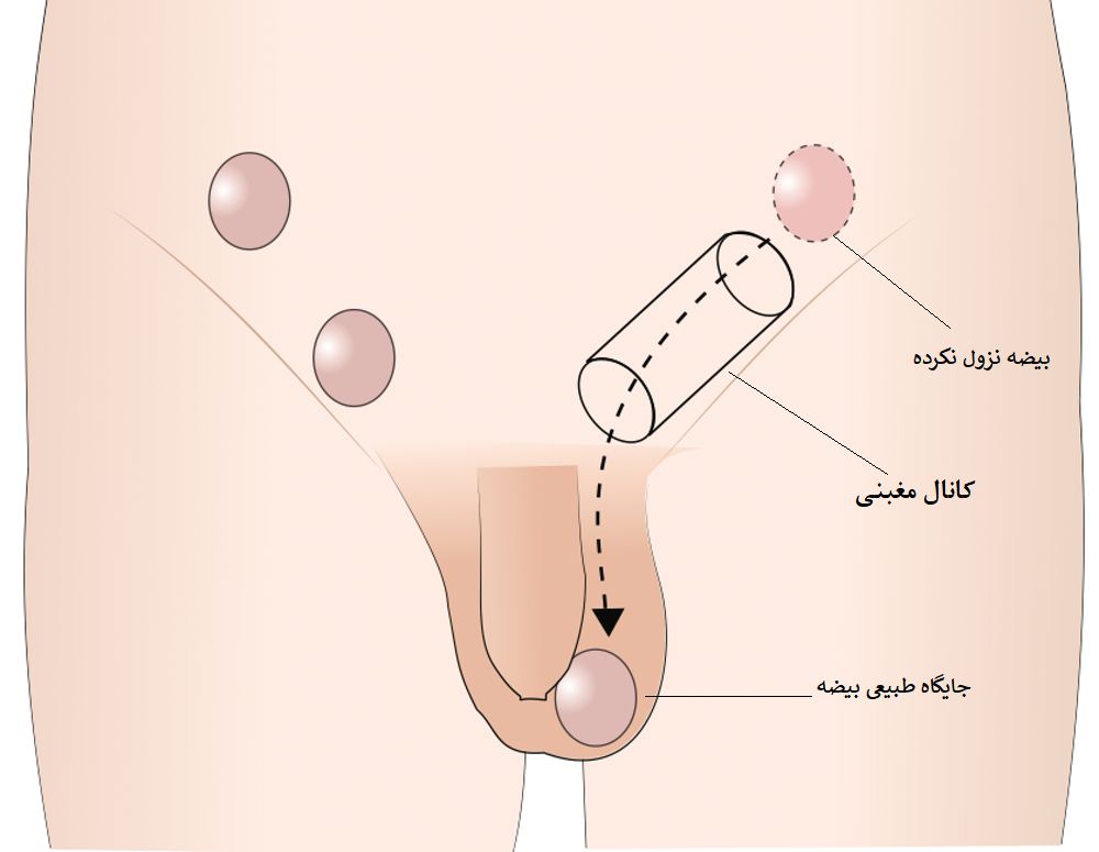 عکس بیضه نزول نکرده