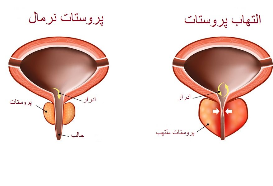 التهاب پروستات