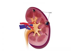 بیماری کیست کلیه