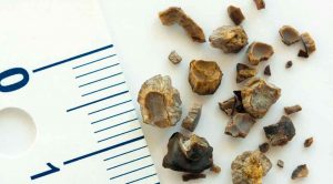 درمان سنگ کلیه با اندازه های مختلف