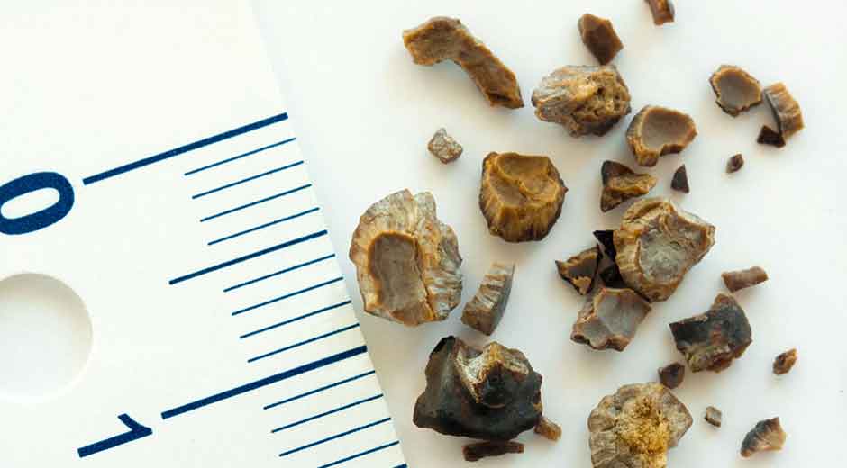 سنگ کلیه با اندازه های مختلف