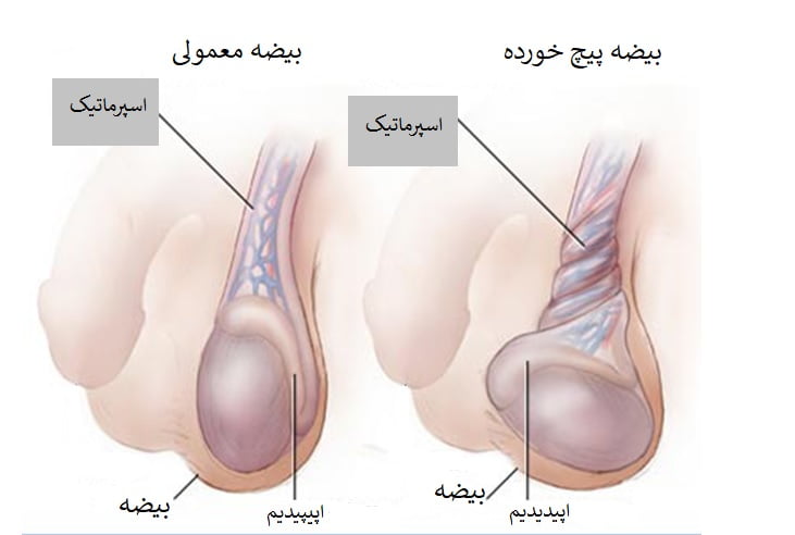 آیا عمل واریکوسل باعث اختلال نعوظ میشود؟
