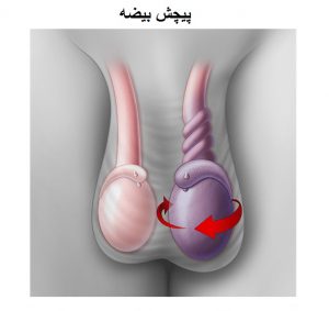 علائم پیچ خوردگی بیضه