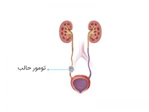 سرطان حالب