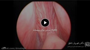 جراحی بزرگی پروستات (TURP)
