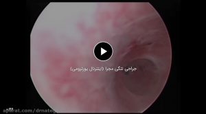 جراحی تنگی مجرا (اینترنال یورترومی)