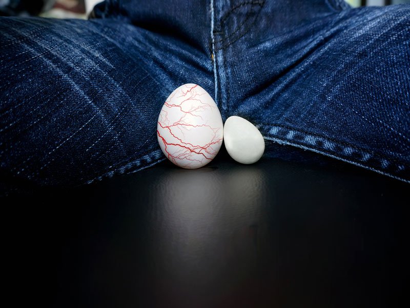 بیماری واریکوسل