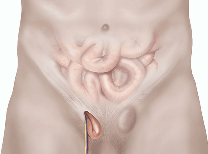 فتق کشاله ران