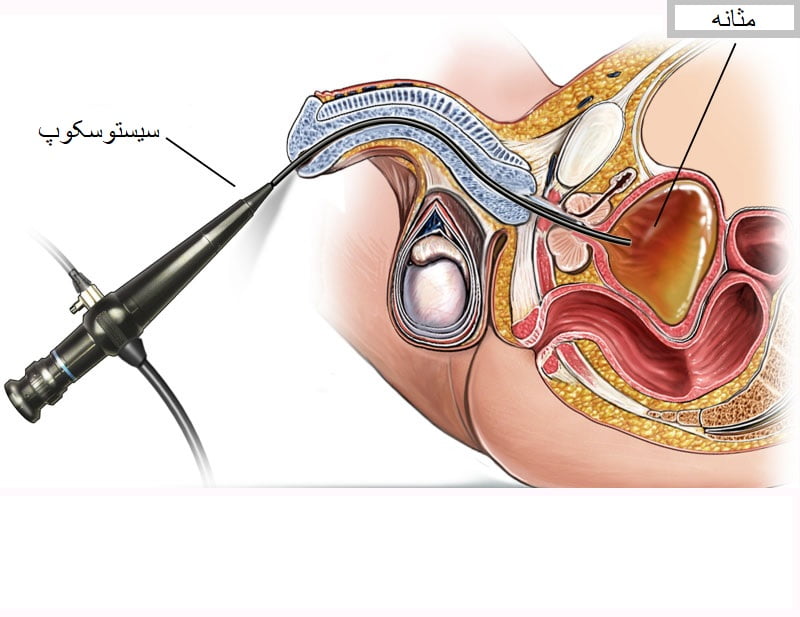 سیستوسکوپی