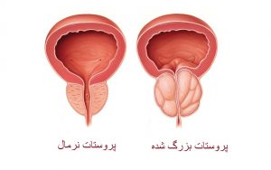 علائم پروستات