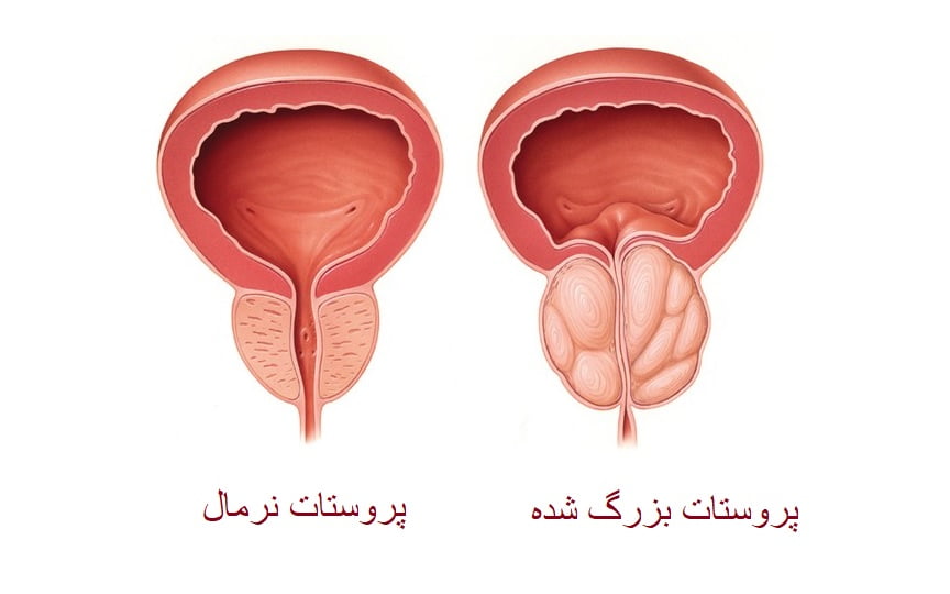 بزرگی پروستات