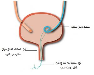 سوند حالب