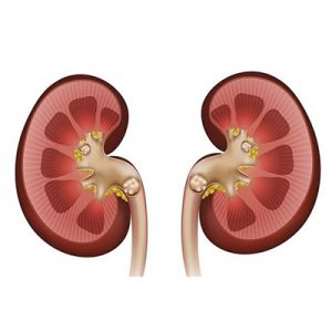 دلایل ایجاد سنگ کلیه - دکتر ناطق بیمارستان آتیه