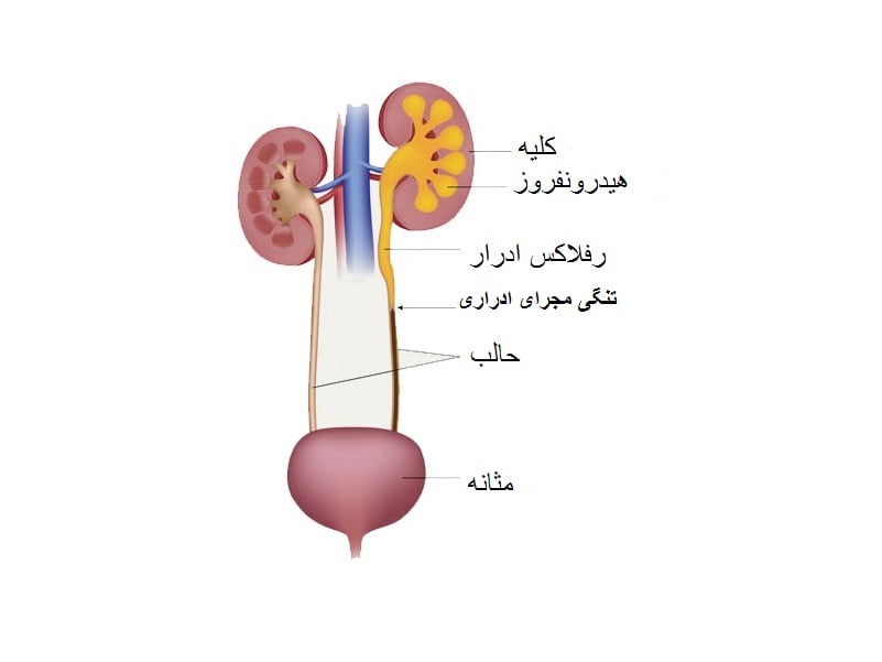 تنگی مجاری ادراری