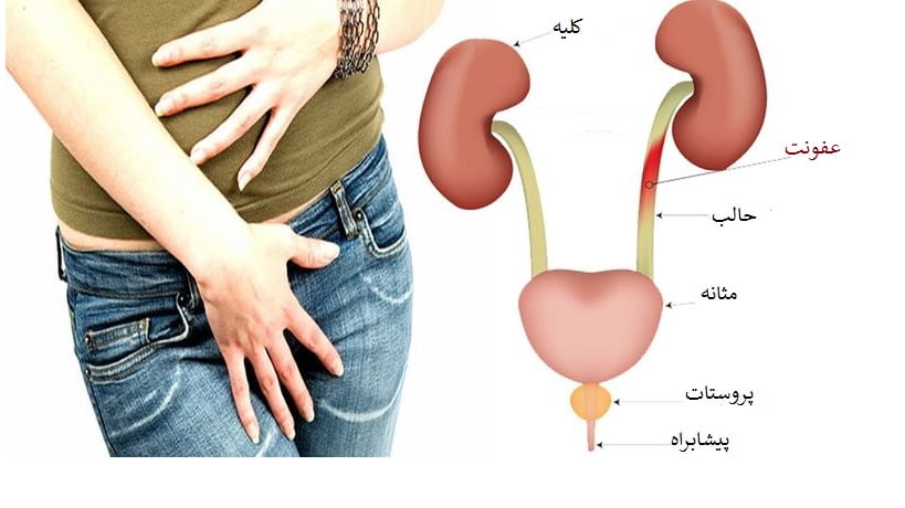 عفونت مثانه