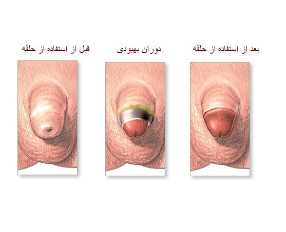 ختنه