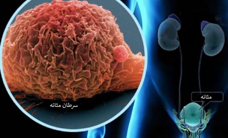 سرطان مثانه