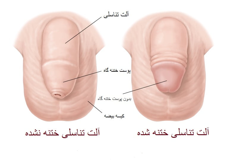 عکس زیاد بریدن پوست در ختنه