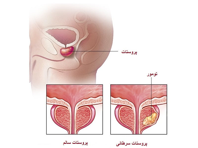 سرطان پروستات