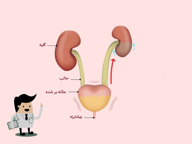هیدرونفروز کلیه