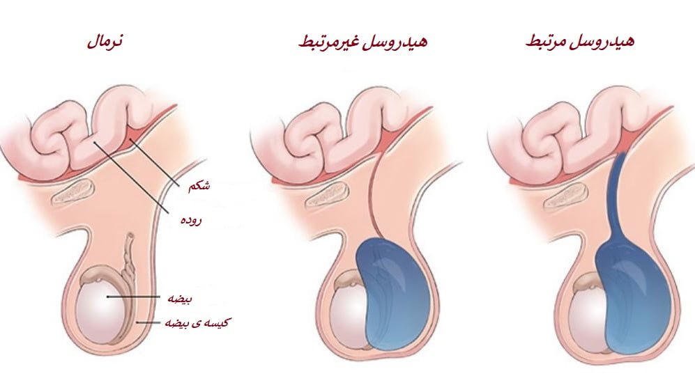 انواع هیدروسل