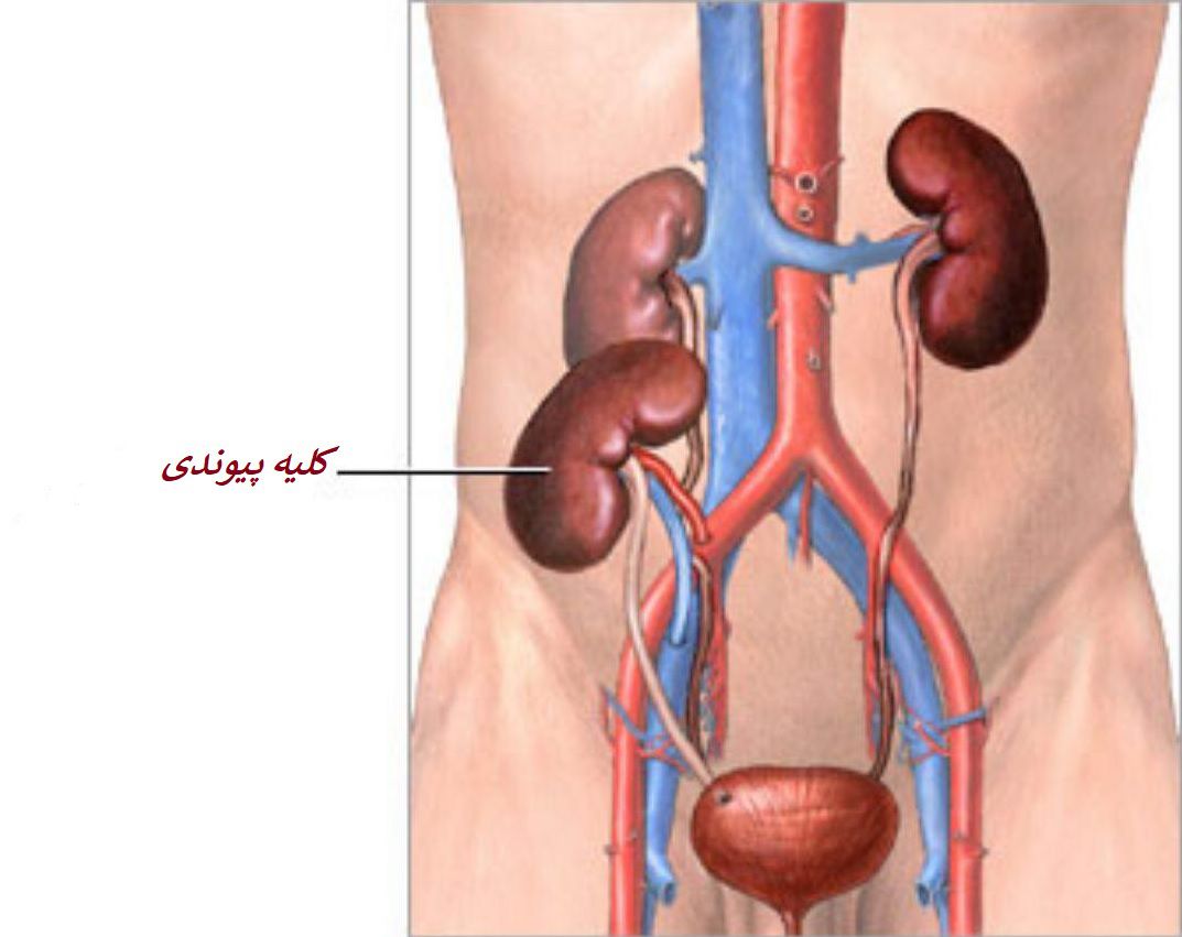 پیوند کلیه