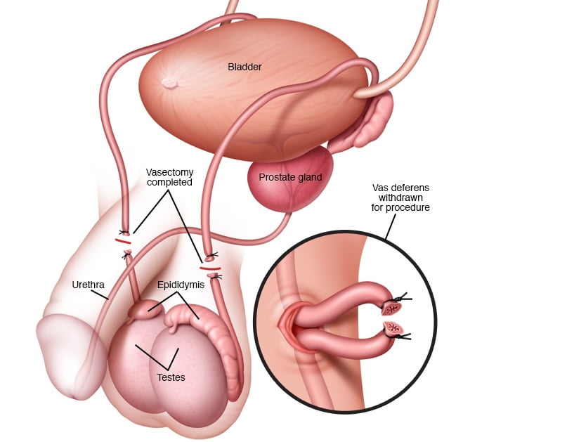هزینه بستن لوله در مردان