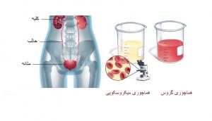هماچوری گروس