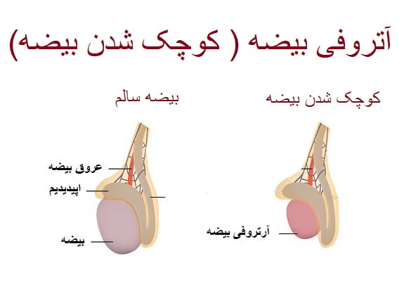 آیا عمل واریکوسل باعث اختلال نعوظ میشود؟