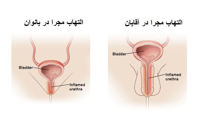 التهاب مجرا