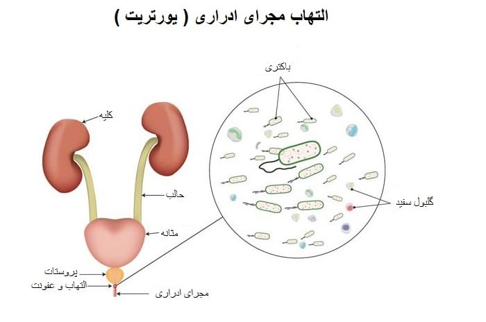 التهاب مجرای ادراری