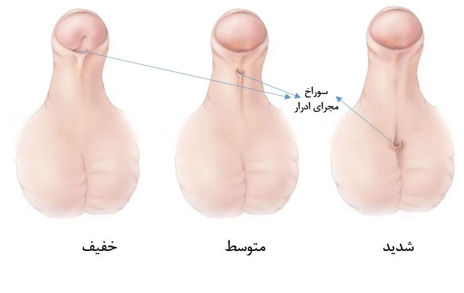 هیپوسپادیاس