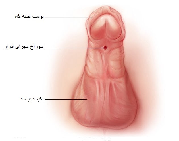 هیپوسپادیاس