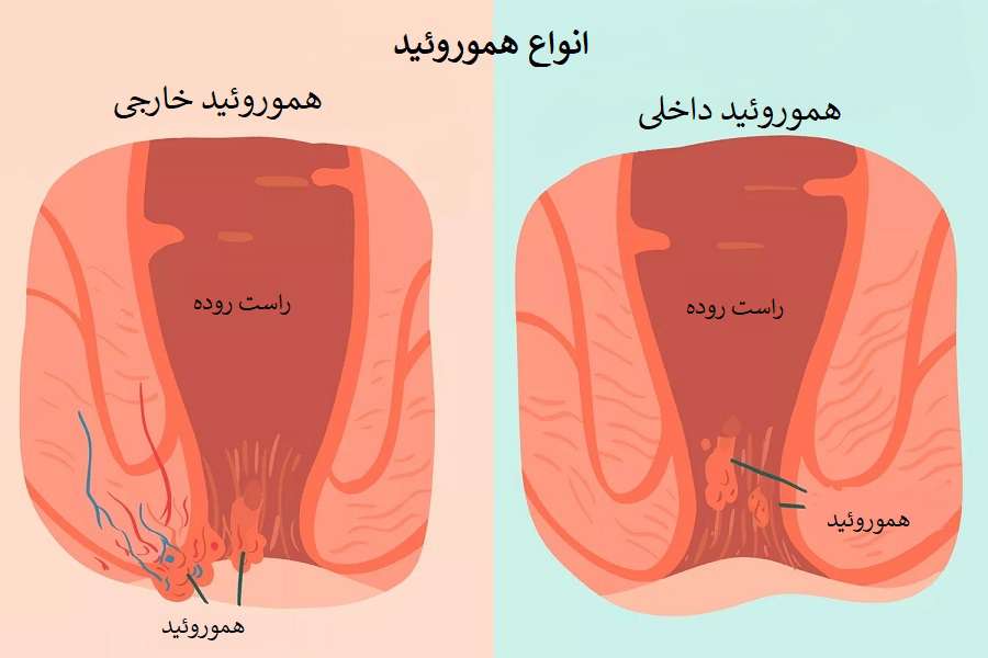 علت مدفوع اغشته به خون