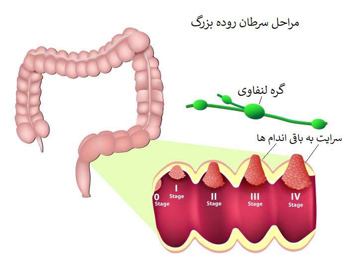 سرطان روده بزرگ علت وجود خون در مدفوع
