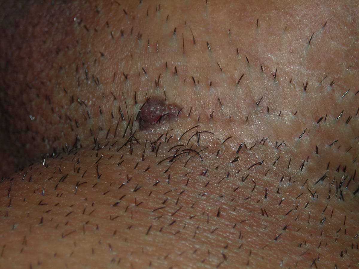 عکس زگیل مقعدی خفیف