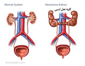 مراقبت از کلیه نعل اسبی