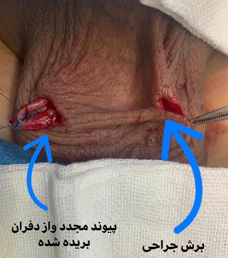 جراحی برگشت وازکتومی