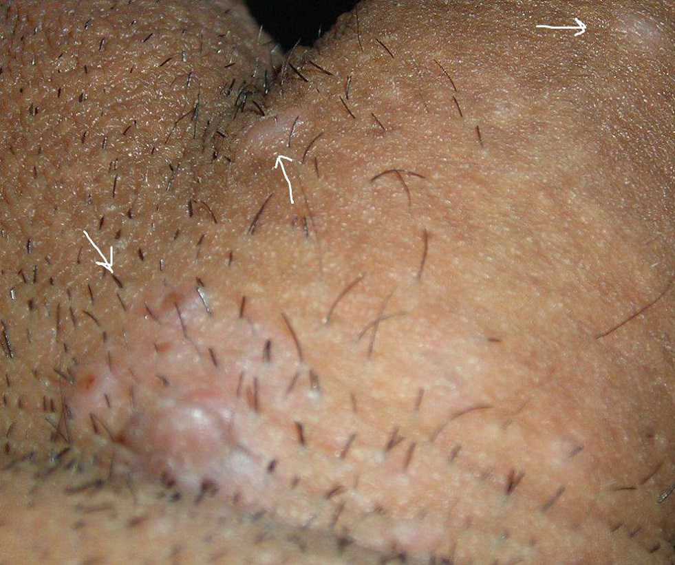 بهترین درمان زگیل تناسلی