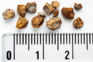 انواع سنگ کلیه
