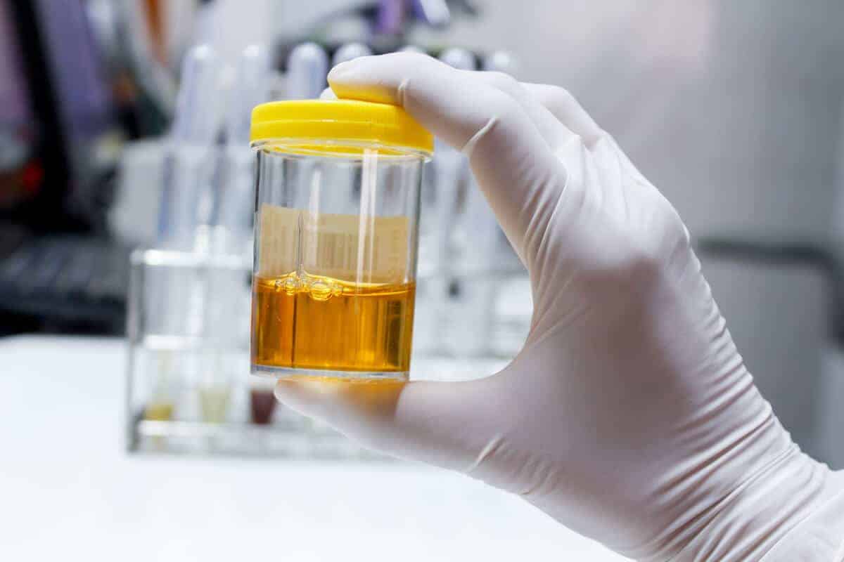 تشخیص سندروم نفروتیک در بزرگسالان