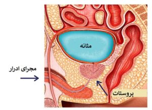 عوامل تشدید کننده پروستات