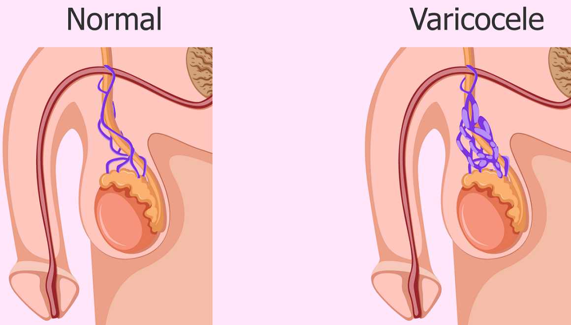 عکس واریکوسل درجه 1