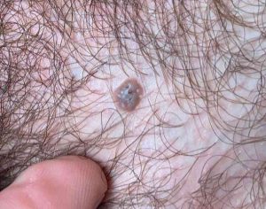 خال گوشتی ناحیه تناسلی